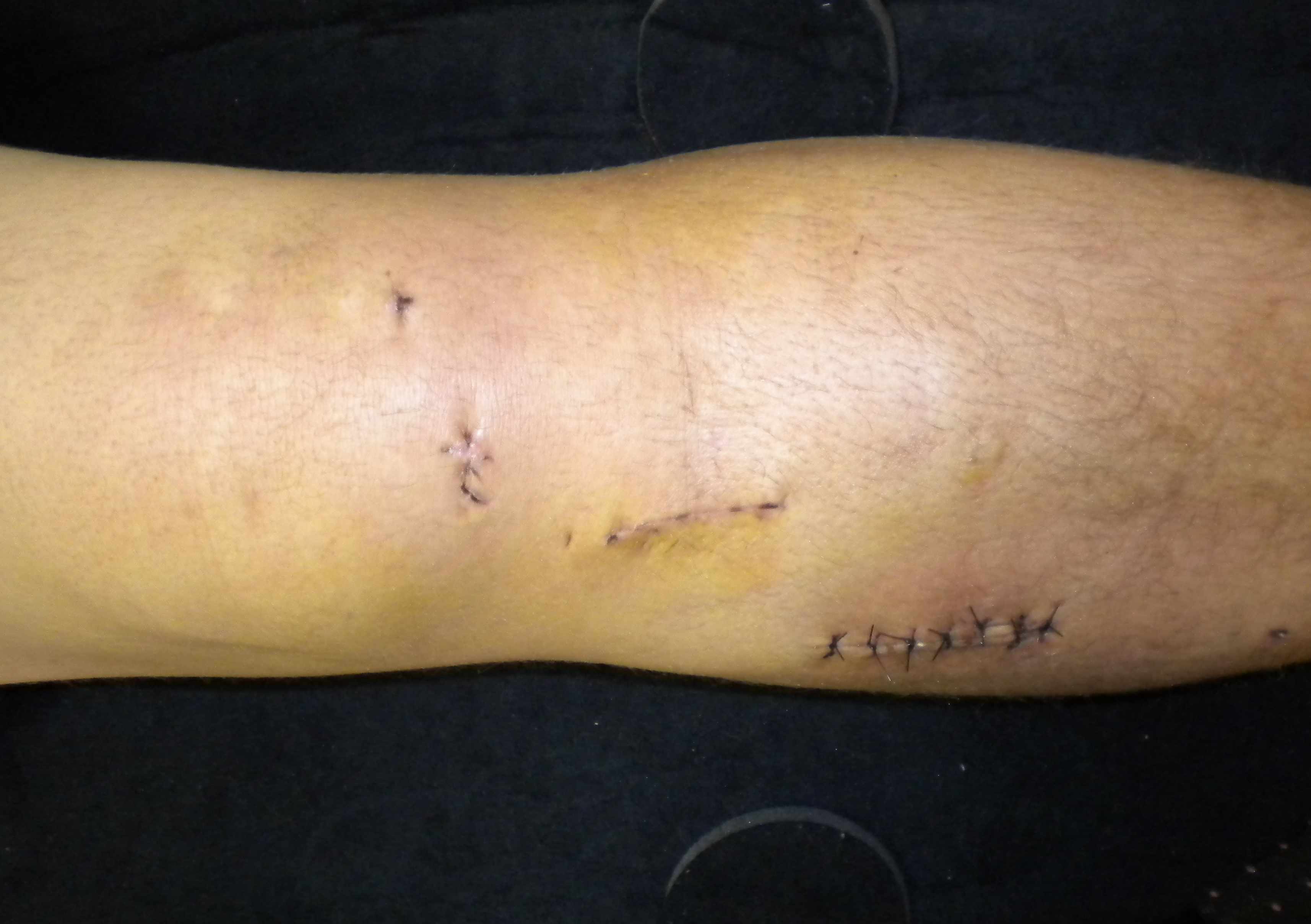 Compartment Syndrome Post ACL Reconstruction